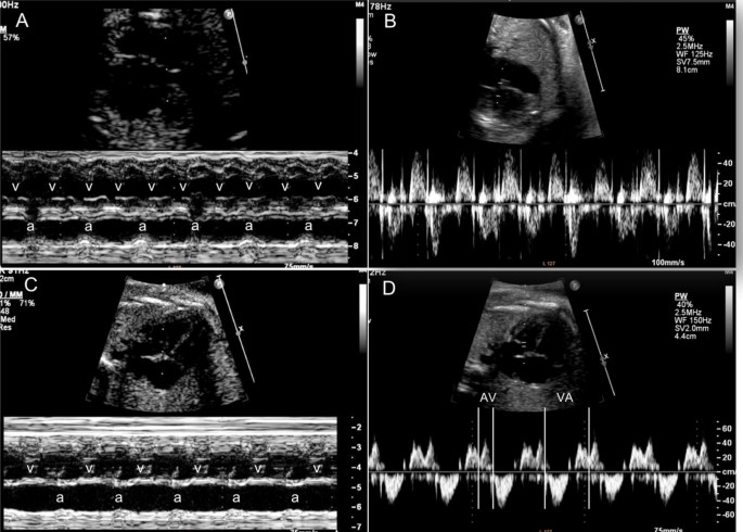Ventricular Arrhythmias